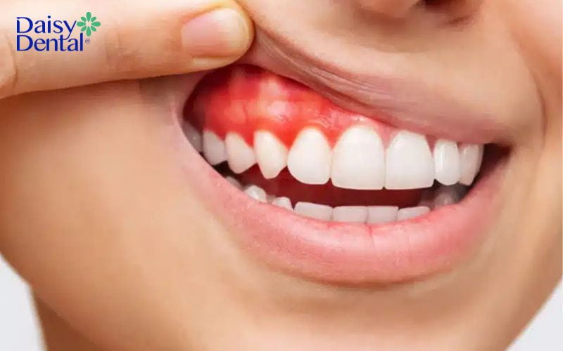 Vệ sinh răng miệng kém là một trong những nguyên nhân hàng đầu khiến bà bầu bị chua miệng