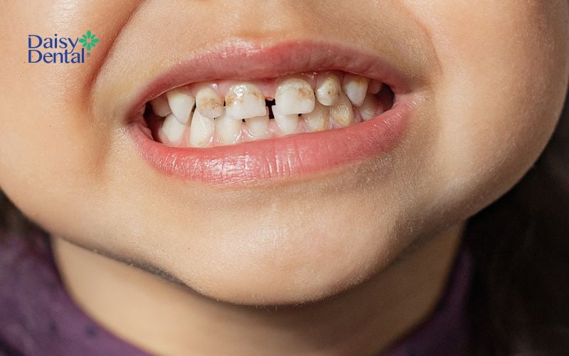 Hiện tượng ăn mòn men răng ở trẻ em làm tăng nguy cơ mất răng sớm
