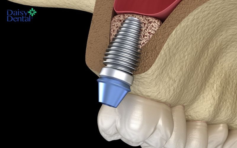 Trụ implant có công dụng thay thế chân răng, được cắm sâu vào xương hàm