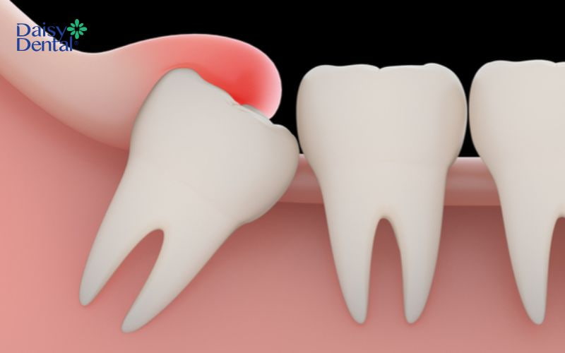 Răng khôn mọc lệch có thể dẫn đến tình trạng viêm nhiễm ở nướu