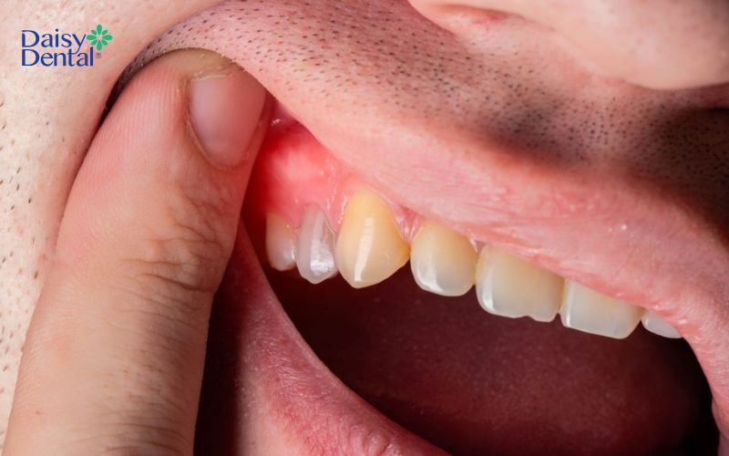Sưng mọng răng không được điều trị dễ gây ra viêm chân răng