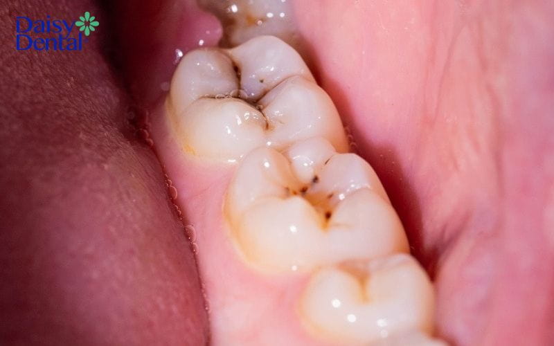 cách làm hết nhức răng nhanh nhất