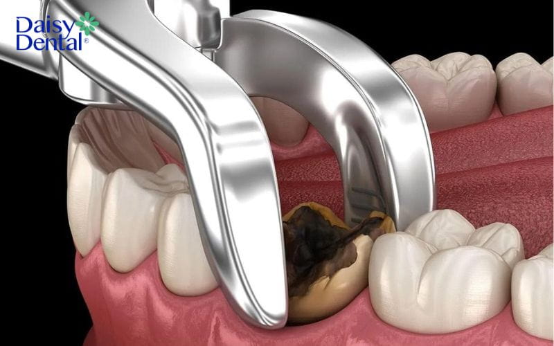 cách làm hết nhức răng nhanh nhất