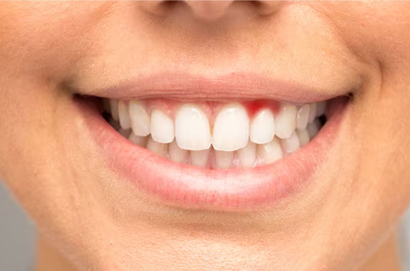 Trong thời gian bị viêm nướu, bạn rất dễ gặp phải tình trạng chảy máu chân răng khi đánh răng.