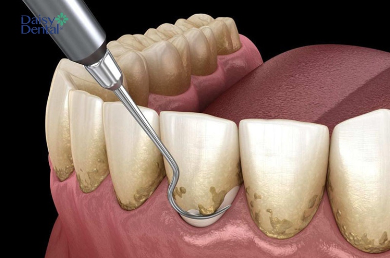Bác sĩ sẽ tiến hành cạo vôi răng để loại bỏ mảng bám, vi khuẩn.