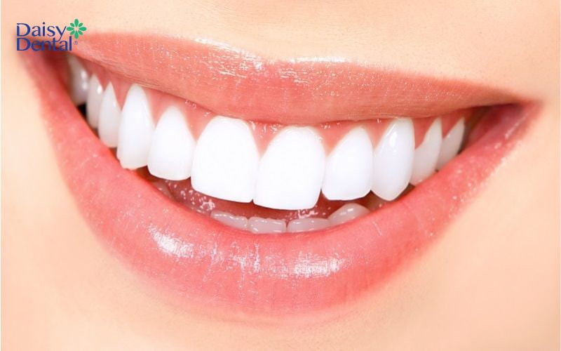 Bọc răng sứ nguyên hàm sẽ giúp cả hàm răng đồng đều, hài hòa hơn