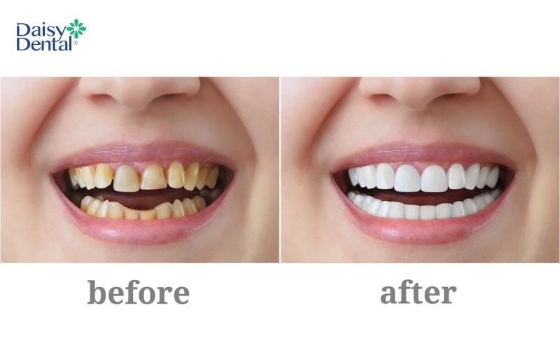 Bọc răng sứ nguyên hàm sẽ giúp khắc phục hoàn toàn khuyết điểm trên răng của bạn