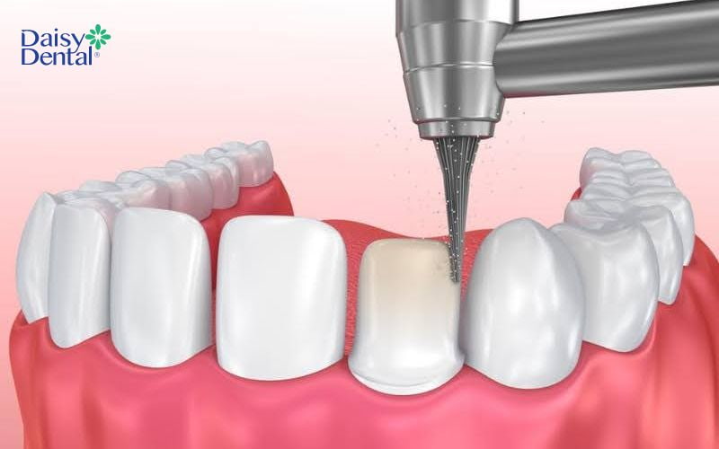 Trước khi bọc răng sứ, bác sĩ sẽ mài răng một lớp mỏng trên răng gốc