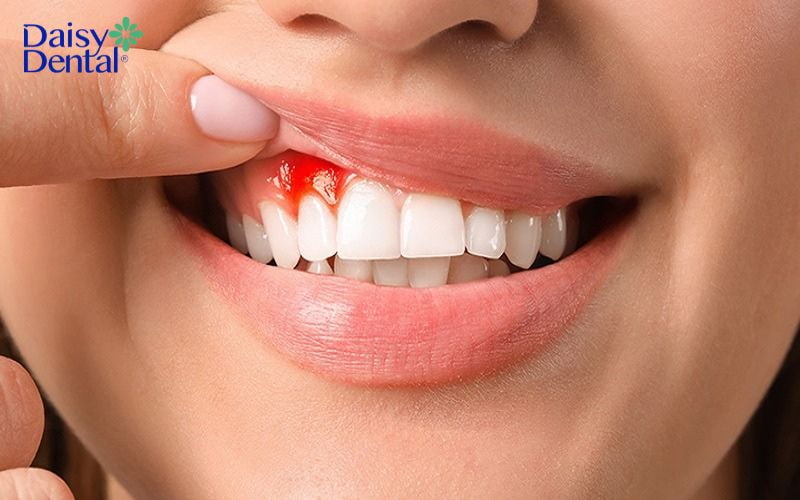 Đánh chung bàn chải đánh răng có sao không
