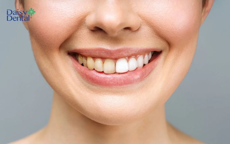 Răng bị lão hóa thường bị ố vàng, xỉn màu hơn so với bình thường