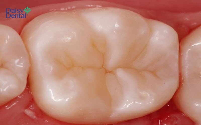 Mặt nhai các răng hàm bị mòn là một trong những dấu hiệu cho thấy răng bị lão hóa