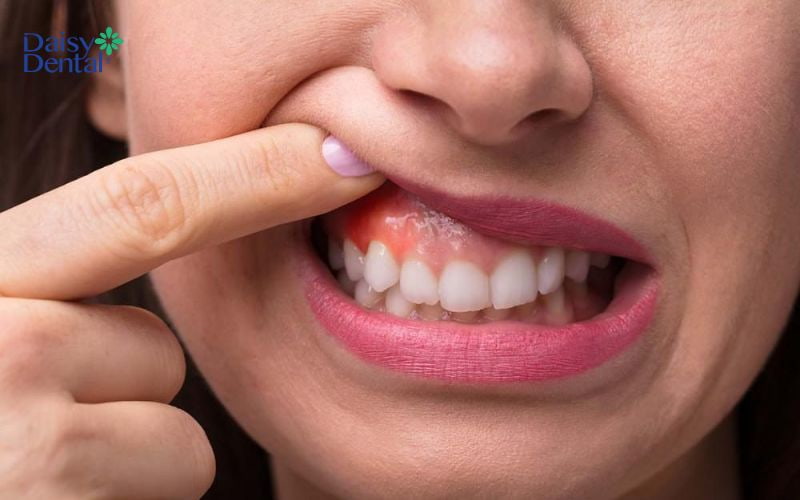 Nếu phát hiện nướu răng bị sưng tấy thì có thể tình trạng răng miệng của bạn đang bị lão hóa
