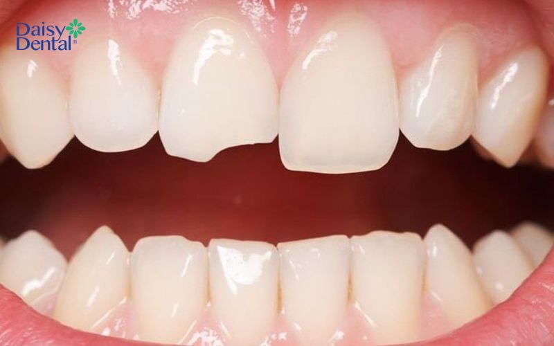 Răng bị lão hóa sẽ yếu hơn so với bình thường và dễ dàng bị mẻ khi ăn uống