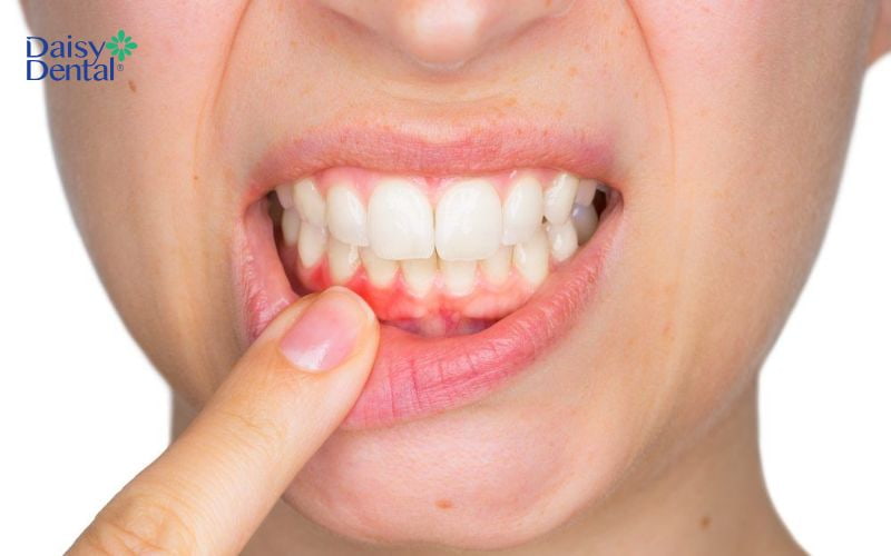 Thường xuyên mắc bệnh lý răng miệng cũng là một dấu hiệu do thấy răng già hơn tuổi