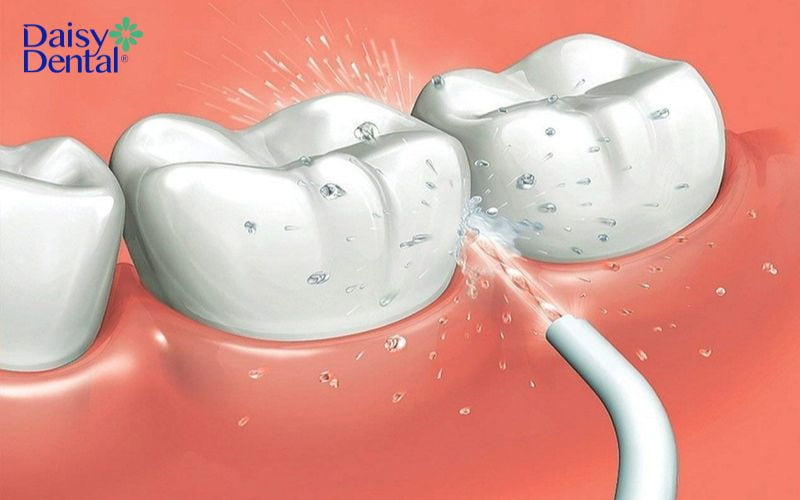 Di chuyển đầu phun để làm sạch bề mặt răng và nướu