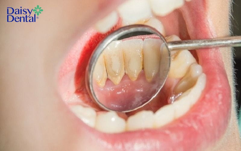 ê răng cửa hàm dưới