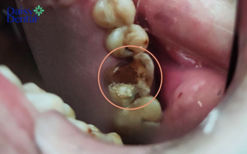 Hậu quả của mất răng số 6 sớm