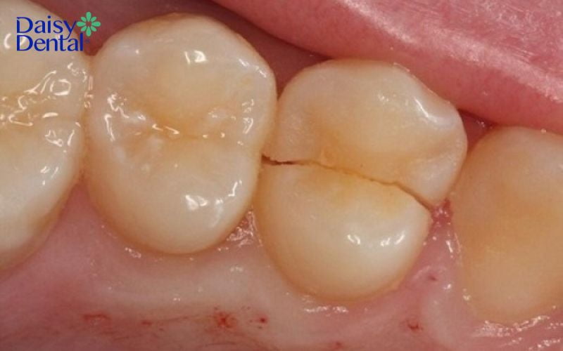 Hậu quả của mất răng số 6 sớm