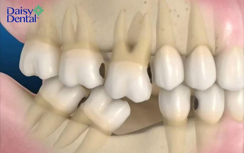 Hậu quả của mất răng số 6 sớm