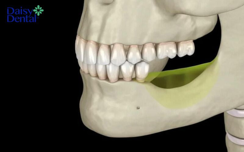 Hậu quả của mất răng số 6 sớm