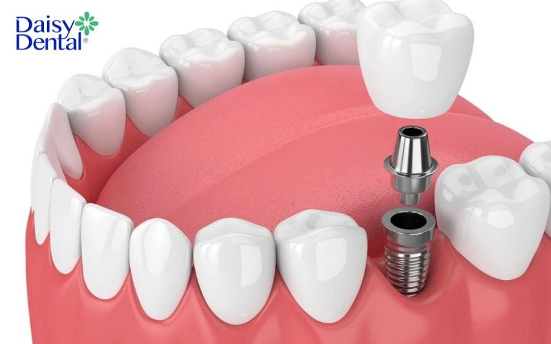 Hậu quả của mất răng số 6 sớm