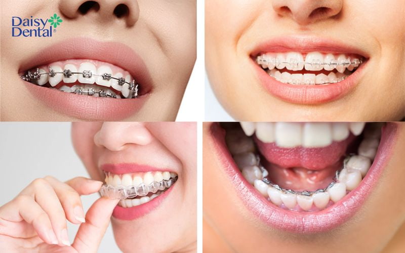 Nẹp răng là phương pháp sử dụng các khí cụ nha khoa chuyên dụng để điều chỉnh răng đều đặn hơn