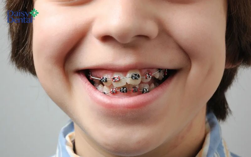 Từ 12-16 tuổi là giai đoạn phù hợp để thực hiện nẹp răng