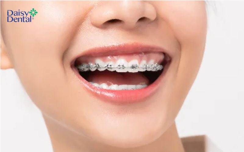 Sử dụng mắc cài kim loại để nẹp răng là phương pháp khá phổ biến