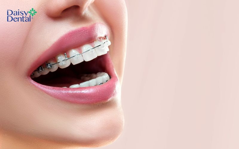 Mắc cài sứ có màu sắc tương đồng với răng thật