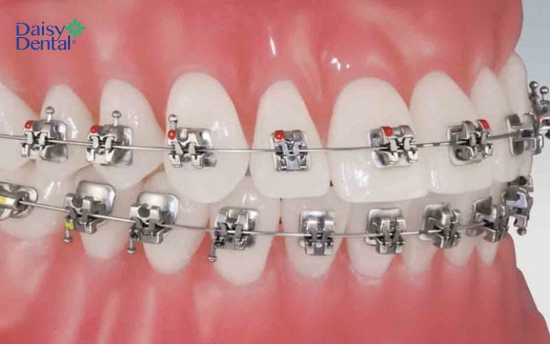 Mắc cài tự động giúp dây cung chắc chắn hơn và không bị bung ra
