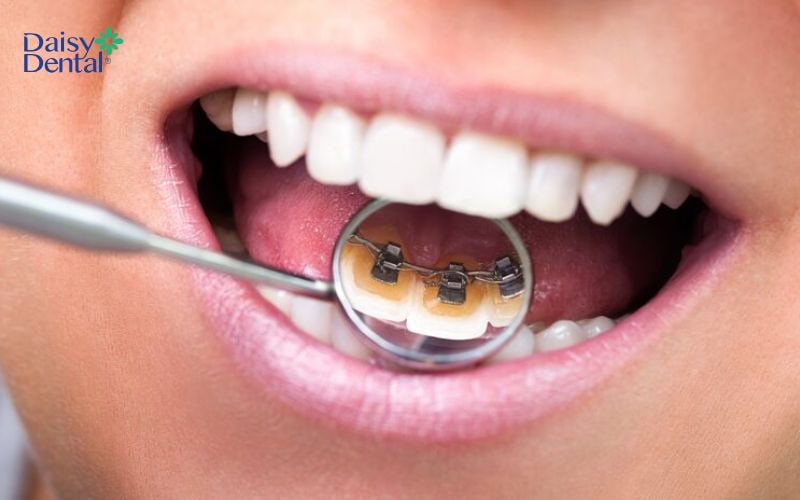 Niềng răng mắc cài ở mặt trong đòi hỏi bác sĩ có tay nghề cao
