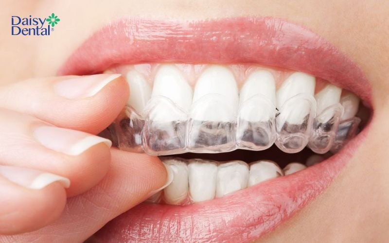 Nẹp răng cùng khay trong suốt Invisalign