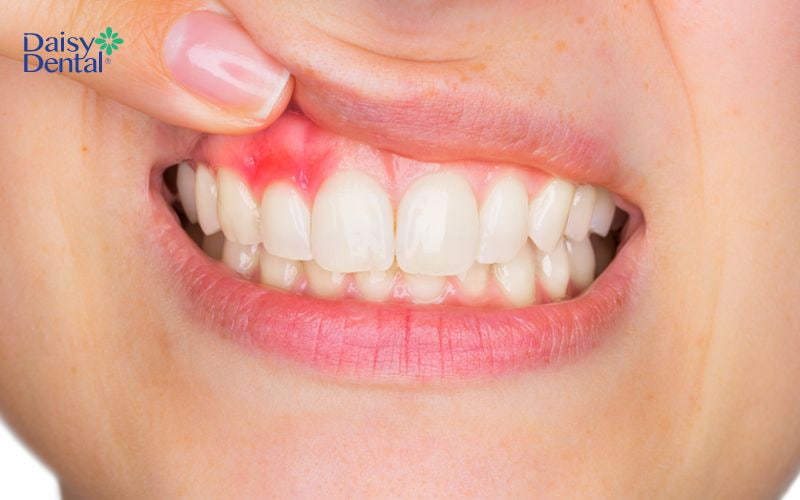 Viêm nướu hoặc mắc phải các bệnh lý răng miệng khác cũng có thể bị sưng lợi