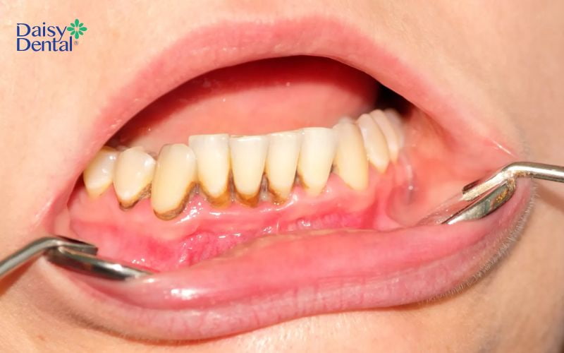 Cao răng bám ở viền nướu, khiến nướu bị tụt xuống phía cuống răng