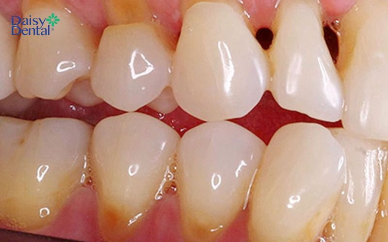 Răng bị lão hóa cũng có thể gặp tình trạng tụt lợi
