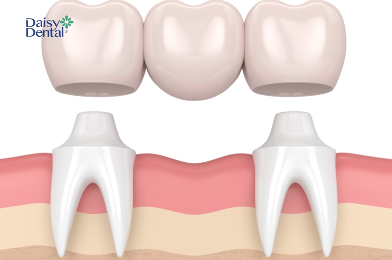 Cầu răng sứ là phương pháp phục hình răng mất phổ biến