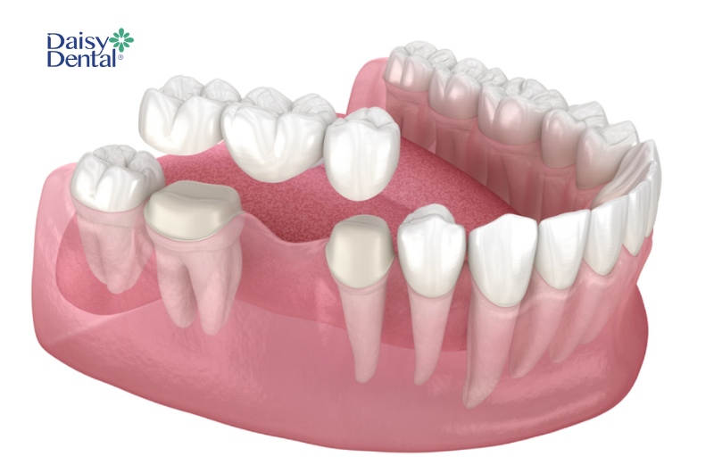 Để thực hiện phục hình răng, khách hàng cần phải có hai chiếc răng trụ khỏe mạnh