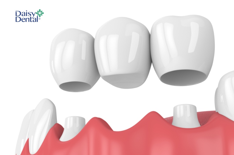 Để làm cầu răng sứ, bác sĩ buộc phải mài nhỏ 2 răng bên cạnh