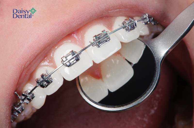 Niềng răng là phương pháp sử dụng hệ thống khí cụ để nắn chỉnh răng về vị trí mong muốn