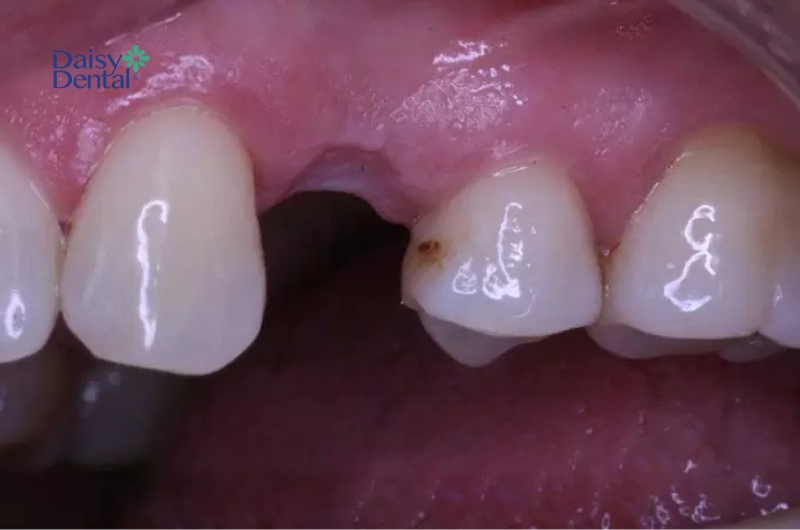 Nếu mất răng số 4 bị mất thì sẽ không mọc lại nữa