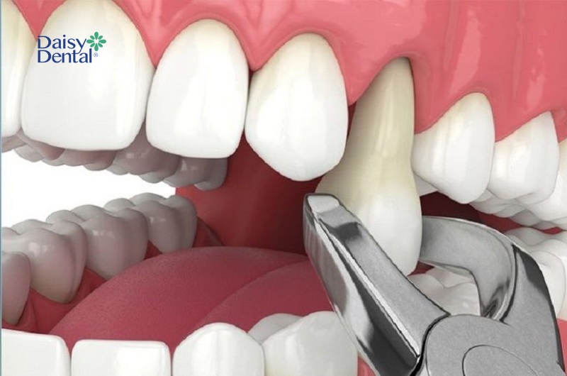 Bác sĩ có thể chỉ định nhổ răng số 4 trong một số trường hợp