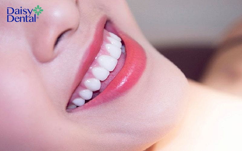 Răng sứ cao cấp có màu sắc tự nhiên và hài hòa với răng thật