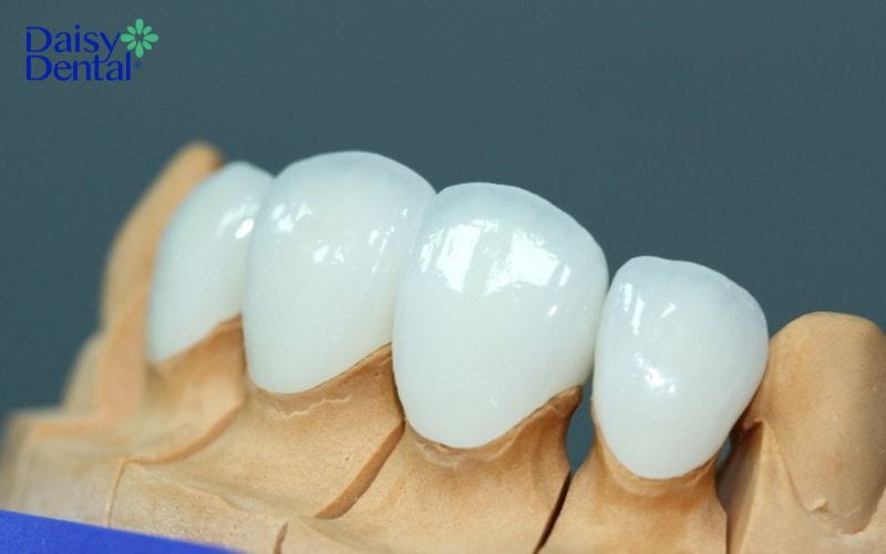 Dòng răng sứ đẳng cấp E.Max