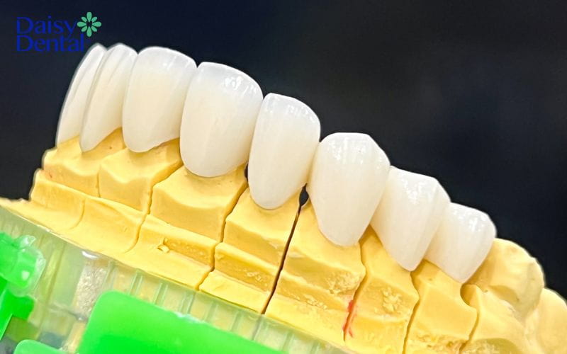 Răng toàn sứ cao cấp Cercon HT