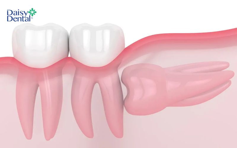Răng mọc trong cùng còn được gọi là răng số 8 hay răng khôn