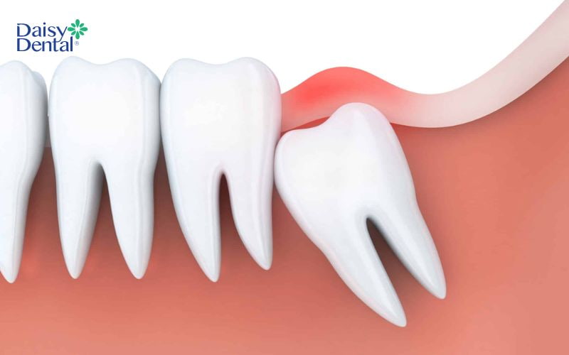Răng số 8 mọc trễ nhất so với các răng còn lại nên thường không còn chỗ trên cung hàm