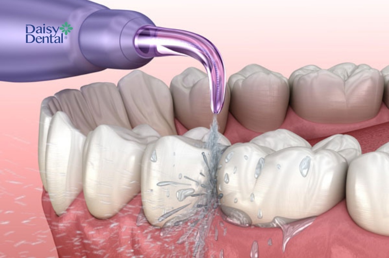 Chọn vòi xịt phù hợp cho từng nhu cầu vệ sinh răng miệng