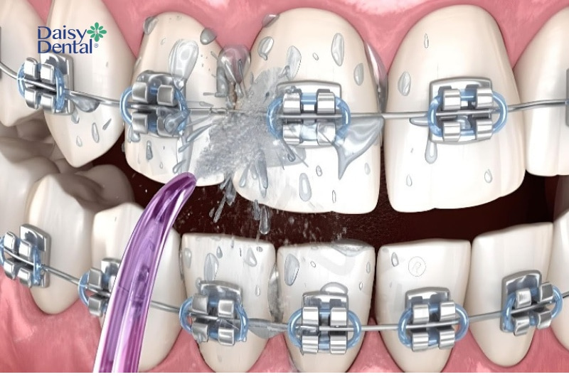 Thiết bị vệ sinh răng miệng này phù hợp với người niềng răng, trồng răng Implant, bọc răng sứ,...