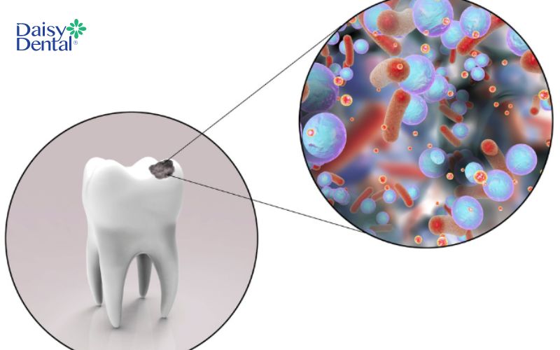 Nguyên nhân gây sâu men răng chủ yếu do vi khuẩn Streptococcus Mutans