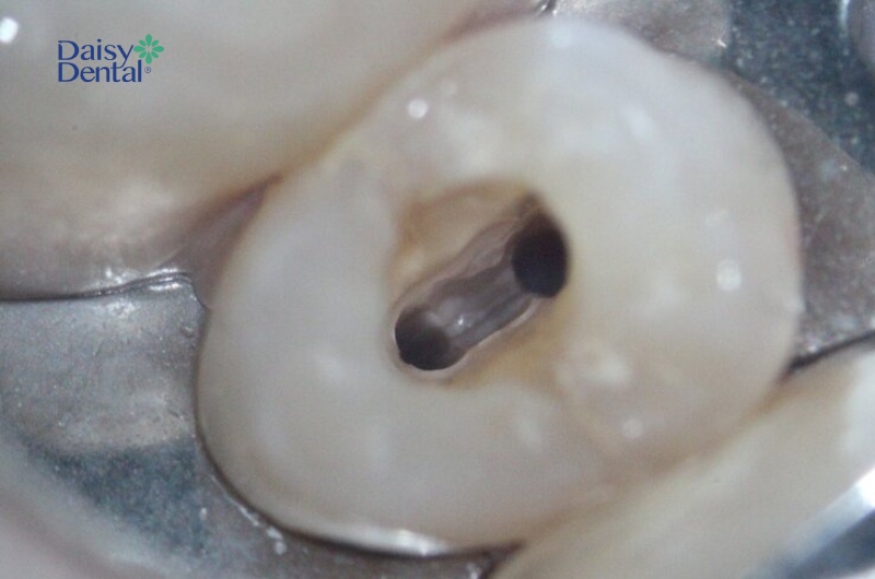 Bệnh sâu răng rất phổ biến, có thể xuất hiện ở nhiều độ tuổi khác nhau